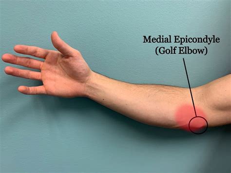 medial epicondylitis golfer's elbow.